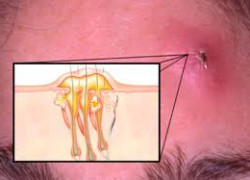 Причины возникновения фурункула